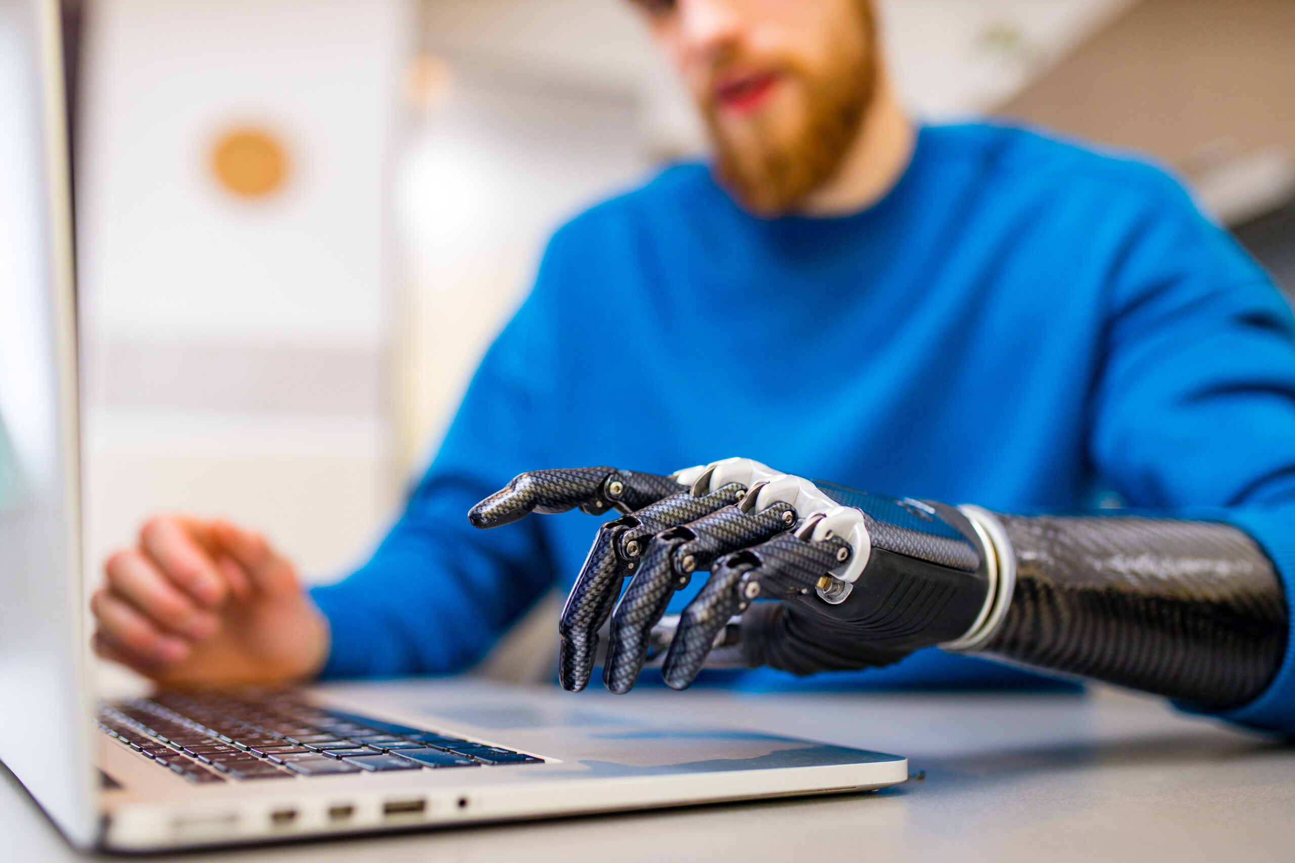 young man working freelance in laptop at home with prosthetic arm